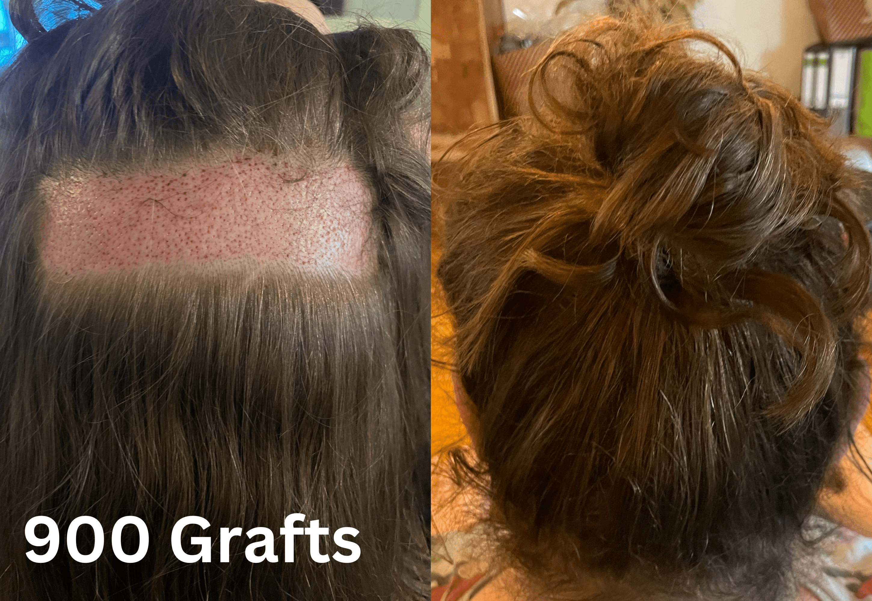 Haartransplantation bremen